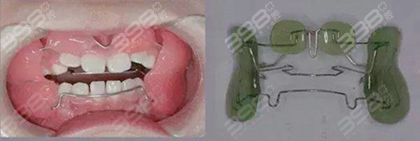 儿童牙齿功能性矫正器多少钱