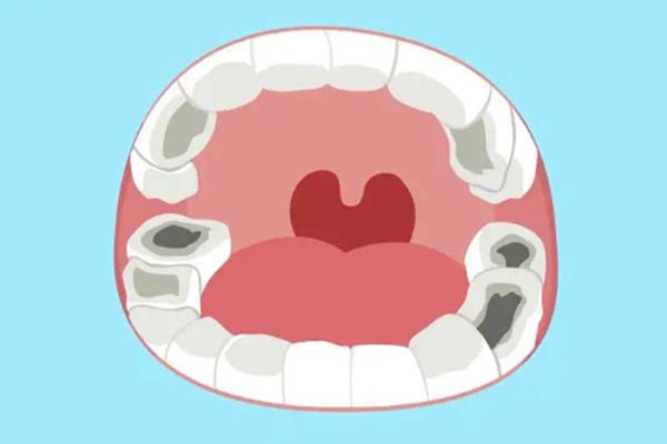 儿童乳牙蛀牙已经烂空了怎么办？有些人说孩子乳牙蛀了不用管