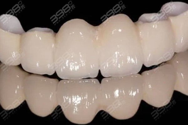 全瓷牙和烤瓷牙的区别在哪里？哪种材料修复牙齿更好呢？