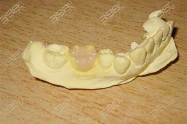 嵌体修复是不是补牙？