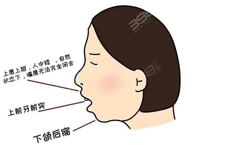 口呼吸对颌面的影响