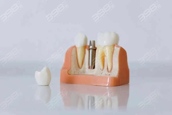 宣城种植牙哪家口腔技术好？公布宣城种牙医生实力强价格便宜的牙科