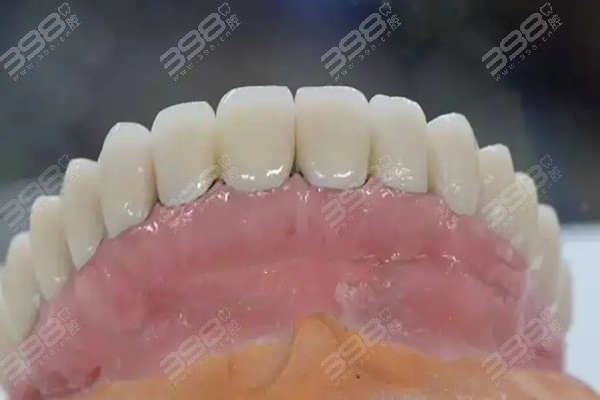All-on-4和/All-on-6种植牙的区别是什么