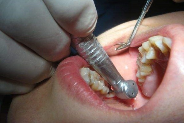 牙齿拔掉能立刻种牙吗？种植牙会对邻牙有伤害吗？