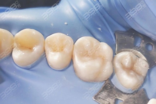 树脂补牙能用几年？告诉你维持补牙寿命的四个因素