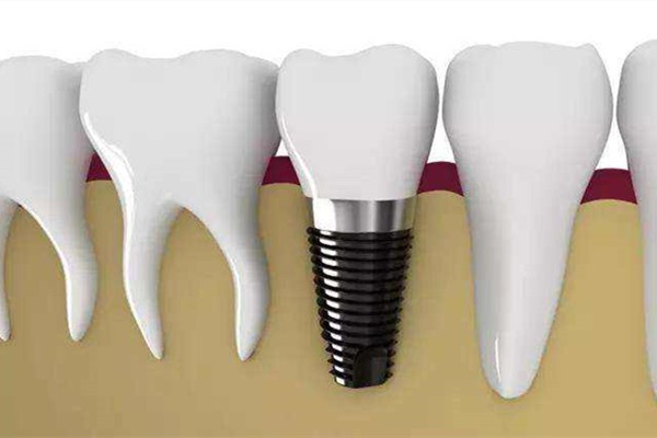 种植牙期间会对日常生活有影响吗？术后可能会出现哪些问题？