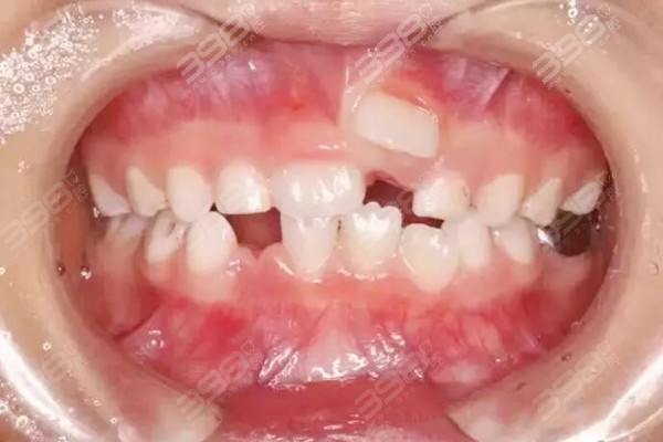 双排牙是怎么形成的