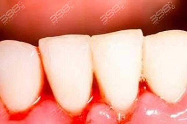 别把牙龈出血不当回事，有可能是口腔疾病引起的