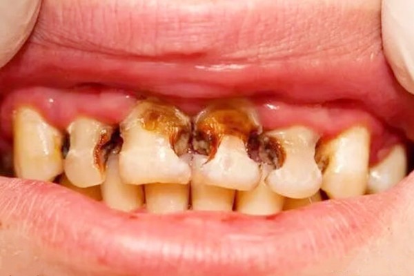 3-6岁儿童龋齿标准图片请查收,对照小孩蛀牙程度快速找到对应办法!