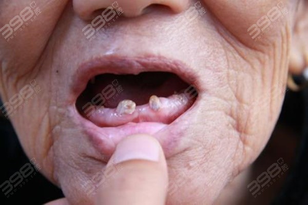 全口义齿容易脱落，通过种植牙能解决吗？