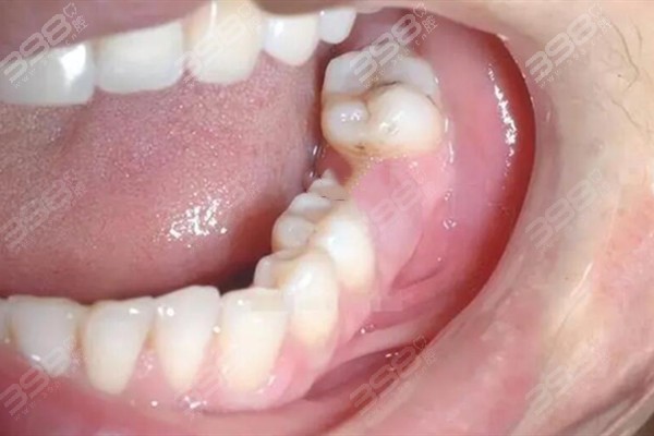 活动假牙适合年轻人吗？20多岁牙齿缺失种牙好还是带活动假牙好？