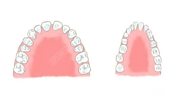 儿童时期的龅牙是怎么形成的