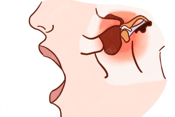 张口受限→颞颌关节病