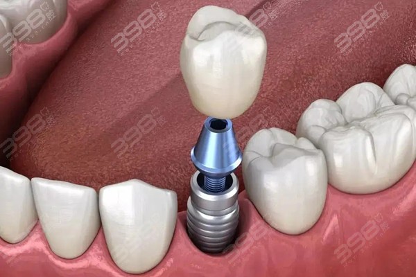 金属过敏体质可以做种植牙吗