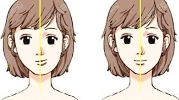 大小脸→左右脸不对称