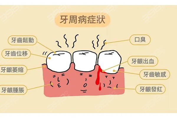 牙周病常见的症状有哪些