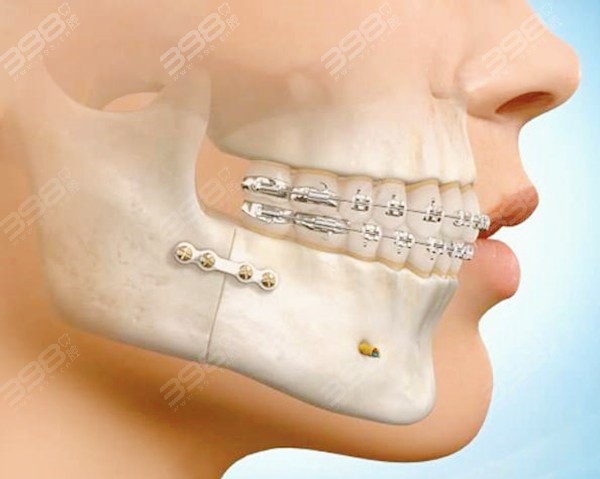 凸嘴是颌骨问题，正颌+正畸联合改善