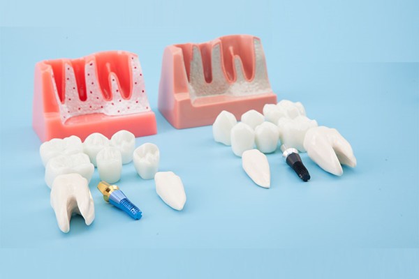 种植牙便宜和贵的有什么区别？有必要选贵的吗？