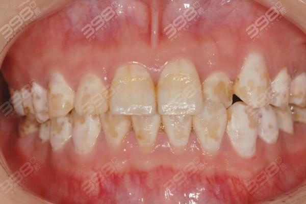 什么是氟斑牙？