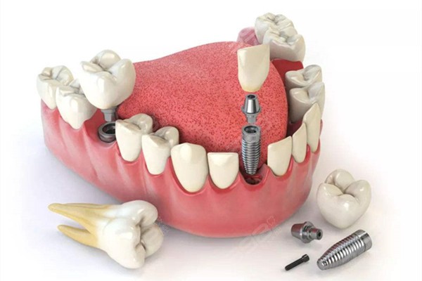 对金属过敏可以种牙吗？术后会发炎吗？