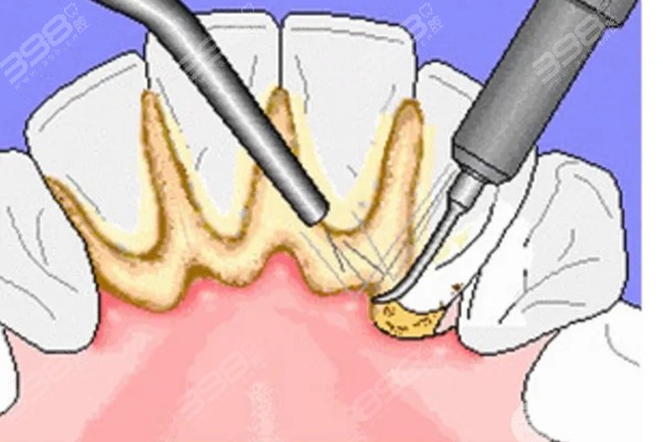 洗牙清洁牙结石会对牙齿造成伤害吗