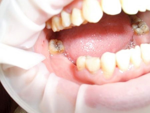 三颗连续大牙坏完了,能一块拔掉做种植牙吗?需要多久种好牙?