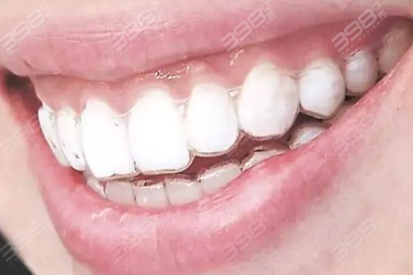 牙齿矫正保持器