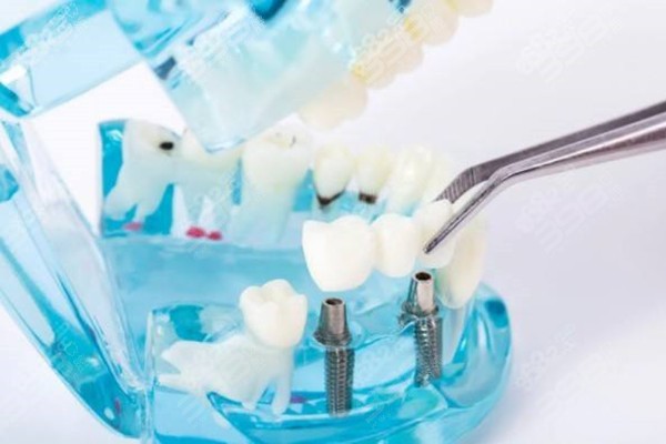 种植牙术后疼吗？种牙后种植牙两边的邻牙疼正常吗？