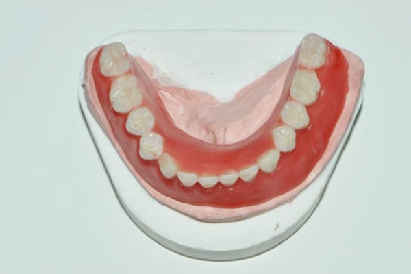 半固定一般需要种植几颗?半/全口固定种植牙是怎么固定的?