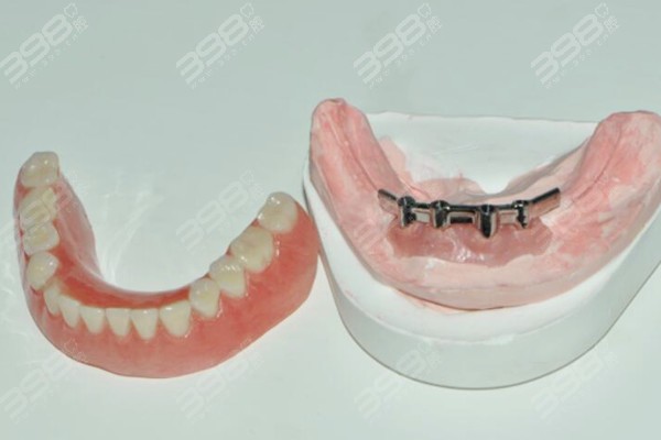 半固定种植牙和全固定种植牙的区别是什么