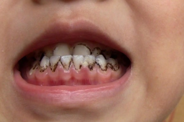 小孩有牙菌斑怎么去除？有关于儿童去除黑色牙菌斑的小妙招