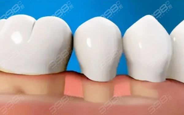 牙龈萎缩能种植牙吗？