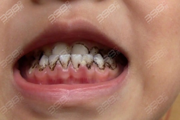 小孩有牙菌斑怎么去除