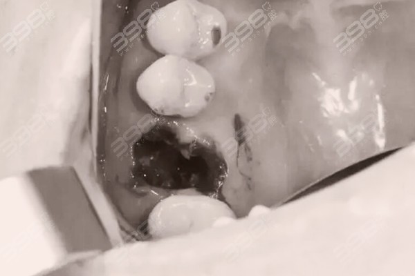 拔牙完的大洞怎么长起来的？
