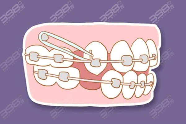 疫情期间不能按时复诊会影响牙齿矫正进展吗？