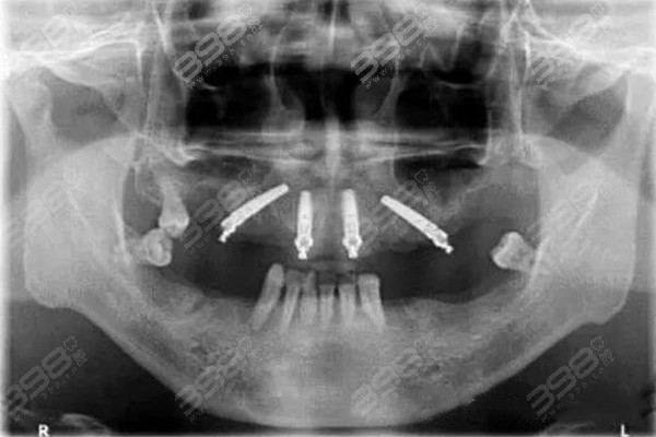 连续缺失7颗牙怎么修复