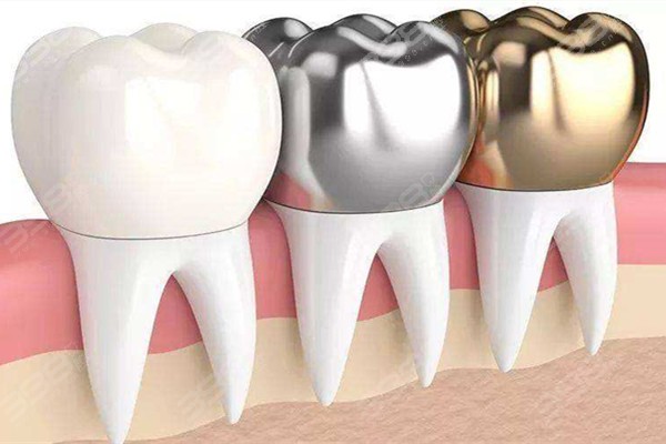 根管治疗失败的牙齿是拔了好吗？如何判断根管治疗是否失败？