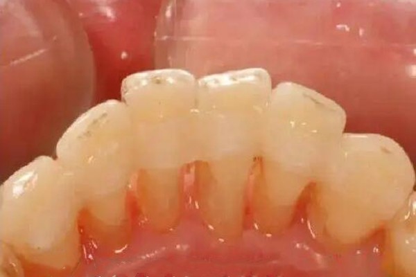 松牙固定术价格贵吗?中老年口腔医院松牙固定术一般固定多久?