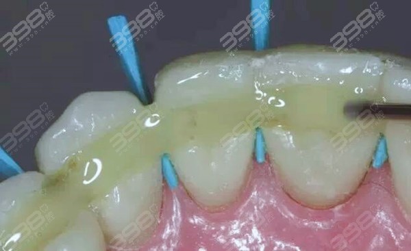 松牙固定术一般固定多久