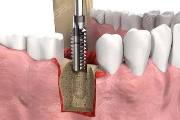 种植牙哪个阶段痛苦？