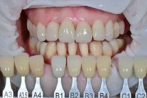 牙贴面有几种材料和品牌以及价格?一篇帮你搞定牙齿美白攻略