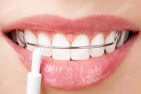 牙齿矫正后保持器要戴多久？