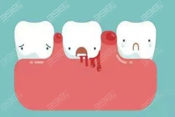 洗牙为什么会出血？