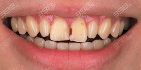 门牙蛀牙做补牙好还是牙贴面好呢?美学修复这样做看起来更真实