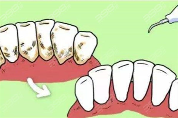 为什么洗完牙后牙缝会变大？想知道洗完牙后牙缝变大多久可以恢复
