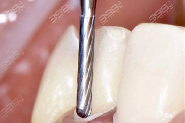 牙贴面拆除后对牙有影响吗