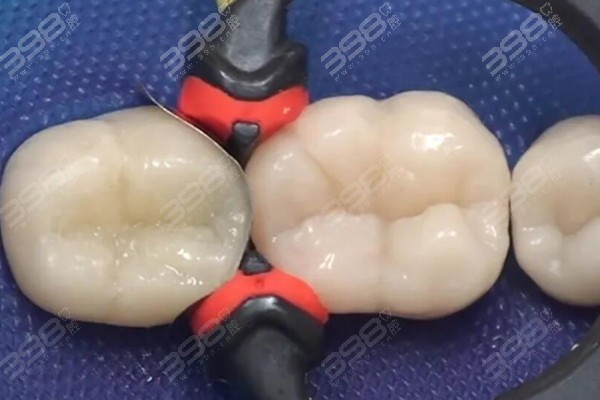 补牙后一般能维持几年？