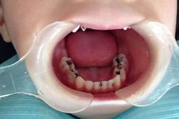 儿童蛀牙有必要做根管治疗吗？有没有副作用？