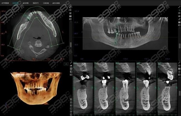 牙医没说的种植牙三大陷阱之牙槽骨骨量不足不能种