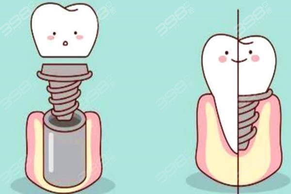 大连齿医生口腔种植牙